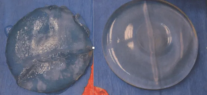 Removed silicone breast implants showing rupture and leakage that caused breast implant illness symptoms